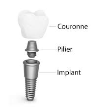 implant dentaire